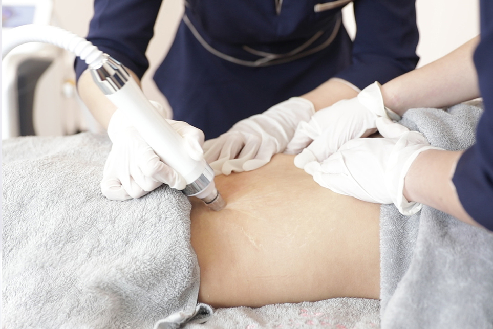 腹直肌修复套餐-4次