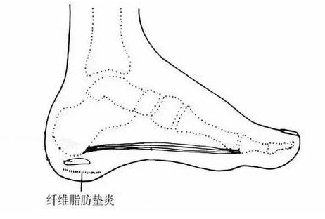产后脚后跟总是痛，原因在这里...用这6个方法帮你改善 ！