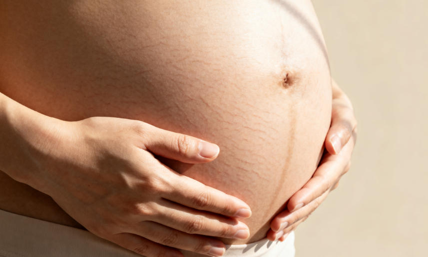 【健康科普】妊娠纹能消除吗？